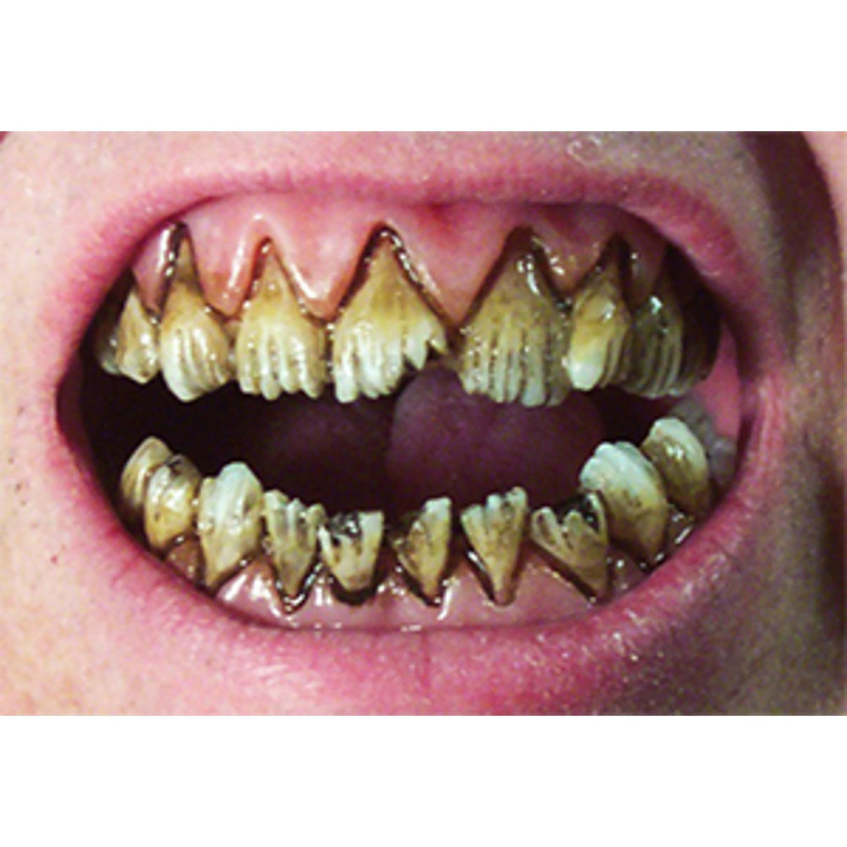 Dental Distortions Kreeper Fx Fangs Kit. — Shimmer & Confetti