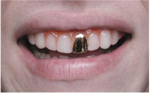Scarecrow Gold Cap Costume Teeth